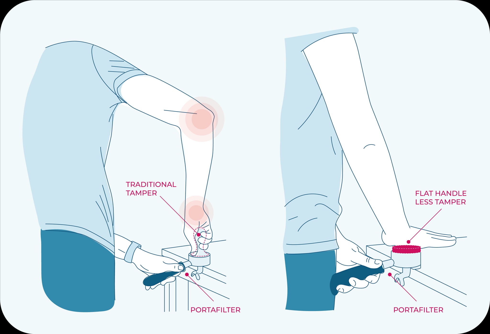“Barista Wrist” the leading cause of injuries in the restaurant trade